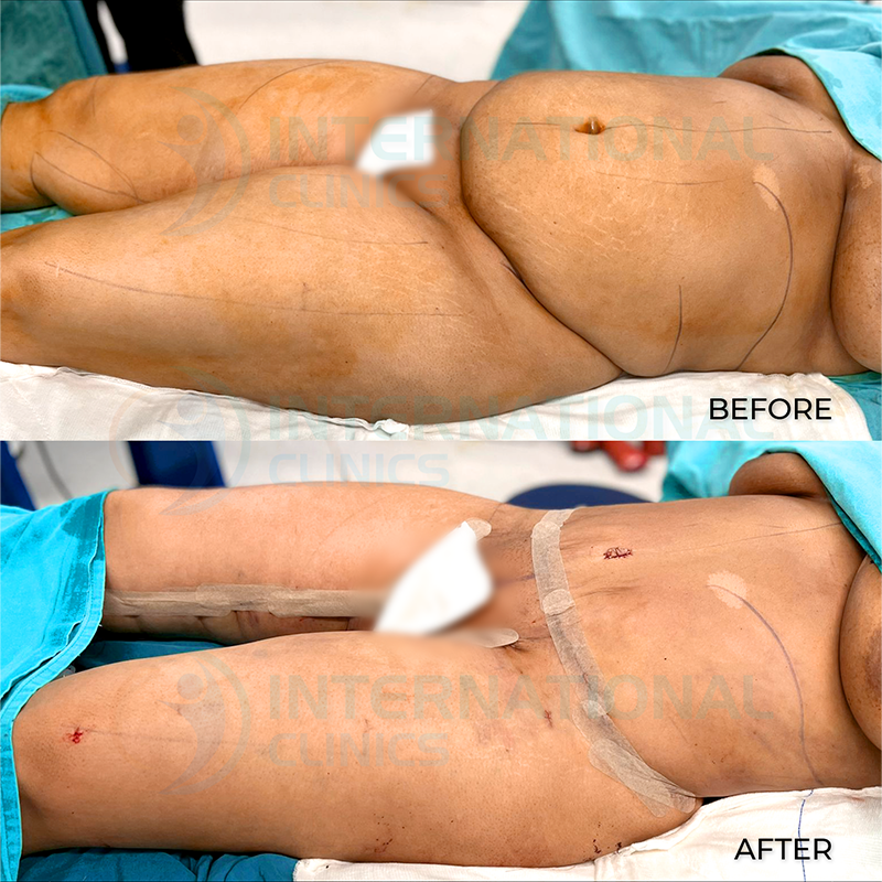  before and after images Mini Tummy Tuck 